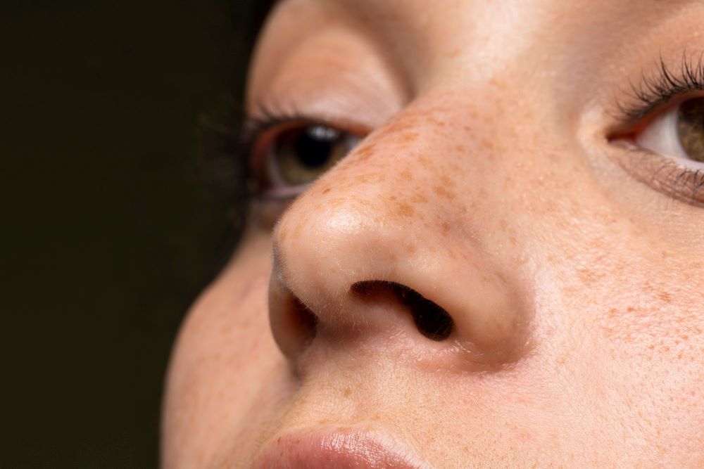 A white woman with textured skin and open pores is having pigmentation on her face
