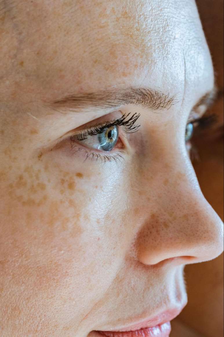 Enlarged pores on the nose and cheeks before treatment