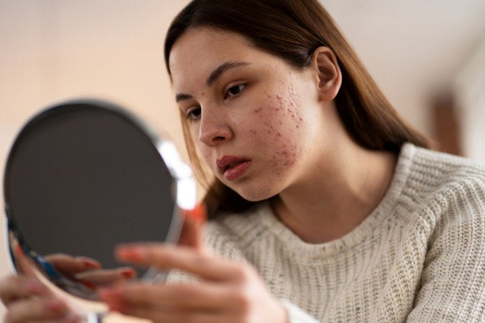 A girl with acne scars is looking into the mirror