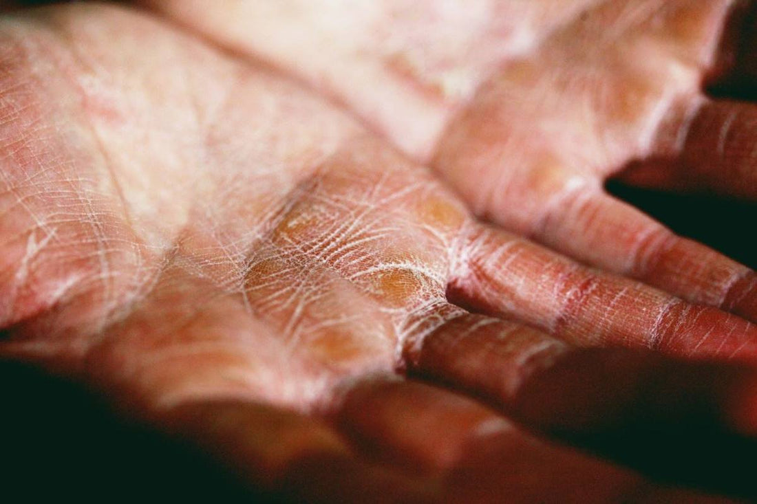 A Guide to Soothing Very Dry Skin