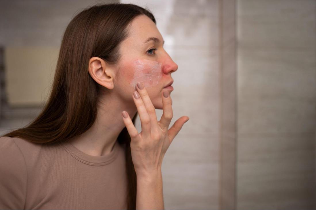 A woman applying moisturiser on her eczema-prone skin