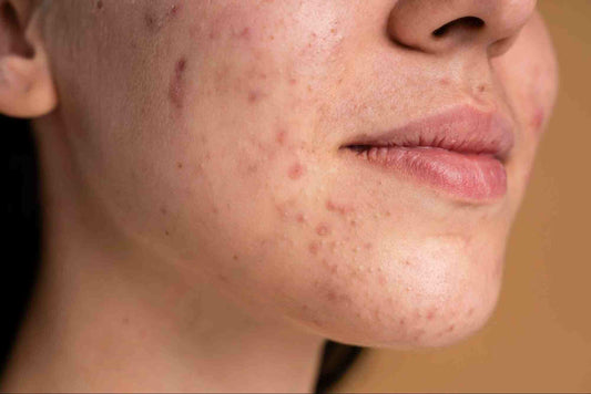 Acne Hyperpigmentation