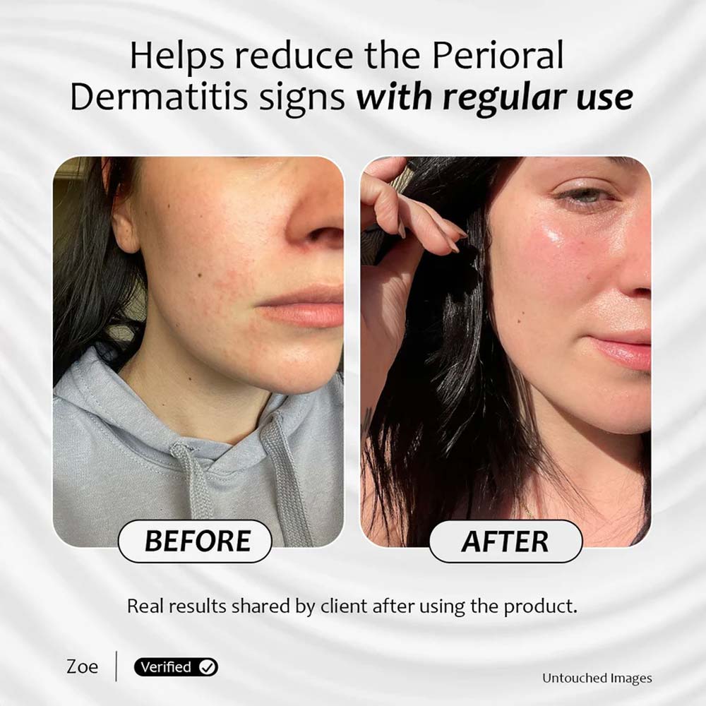 Before and after results of radiance 3d Serum helps reduce the perioral dermatitis signs with regular use