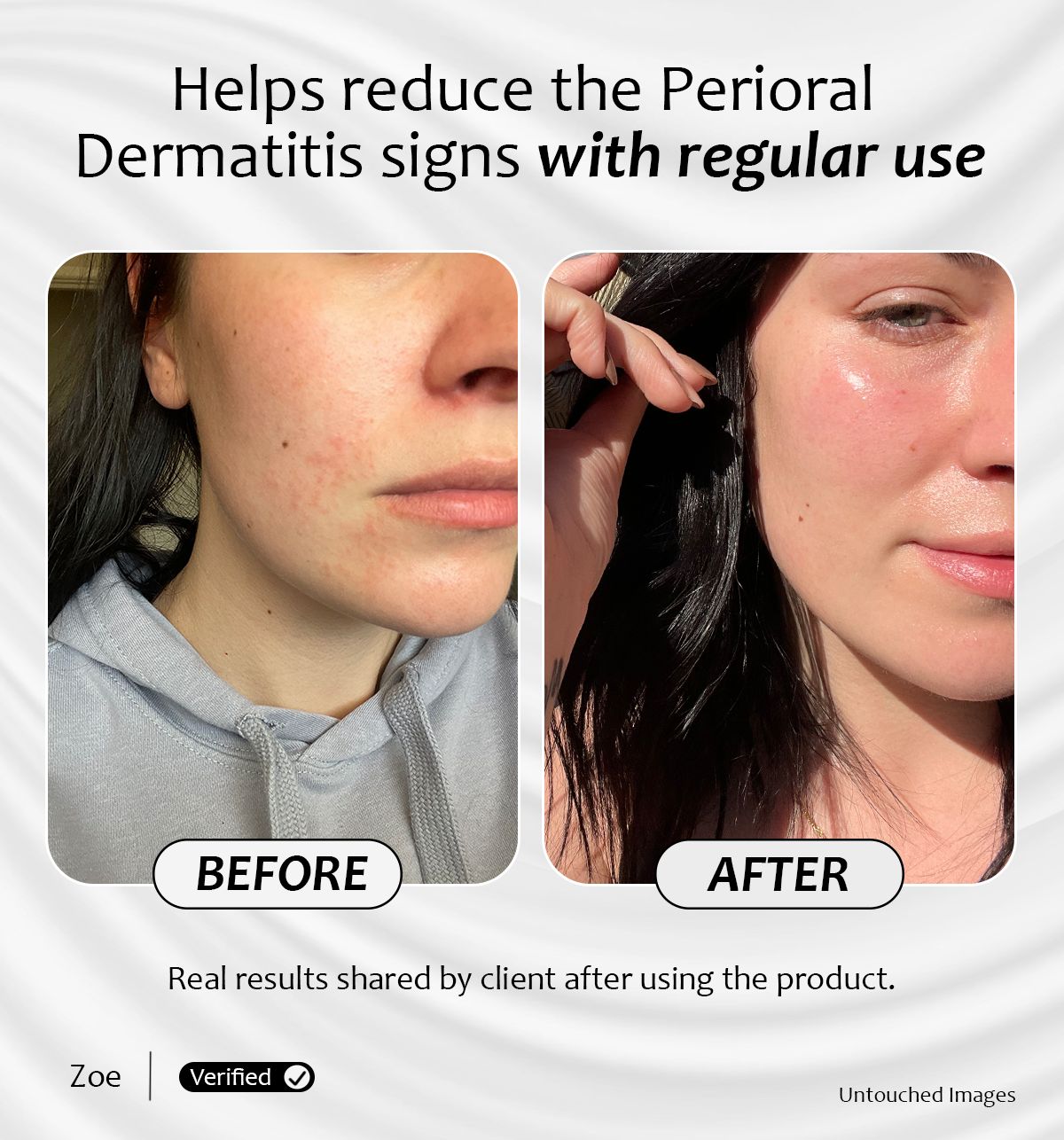 Before and after results of radiance 3d  Serum helps reduce the perioral dermatitis signs with regular use
