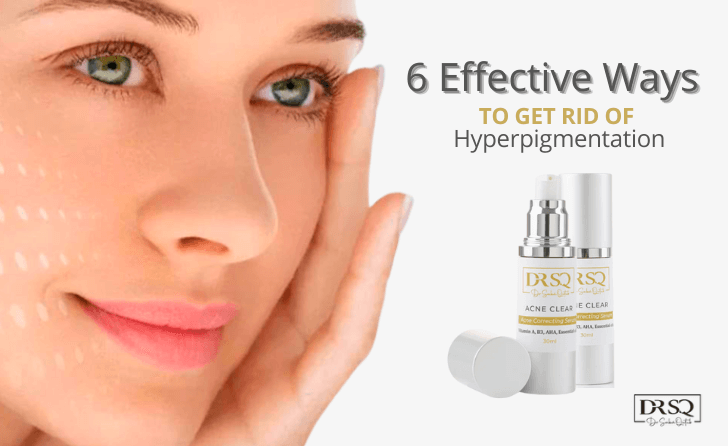 6 Effective Ways to Get Rid of Hyperpigmentation