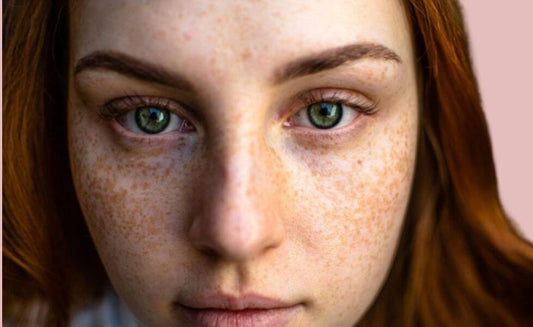 Acne Identification
