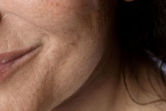 A close-up of a woman’s face with pigmentation and dryness requiring chemical exfoliation