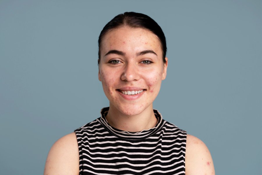 A young woman with acne-prone skin