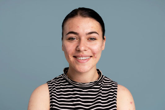 A young woman with acne-prone skin