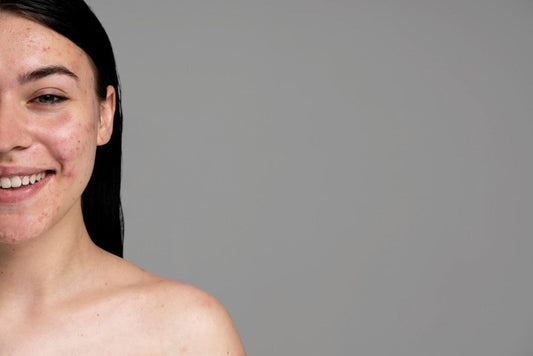 A woman with oily skin has acne marks all over her face