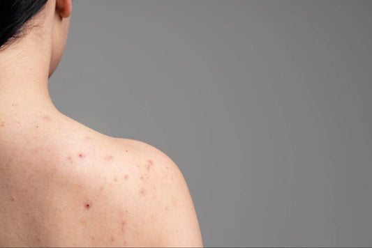 how to treat back and body acne