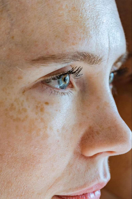 Enlarged pores on the nose and cheeks before treatment