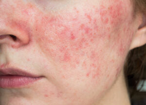 A woman having redness due to sensitive skin