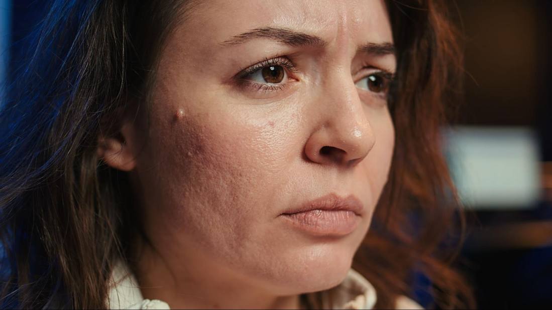A woman with uneven texture on her facial skin