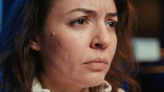 A woman with uneven texture on her facial skin