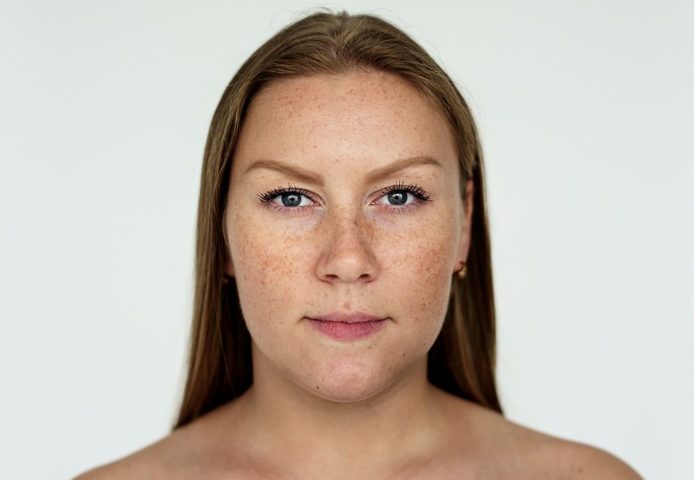 A woman having melasma all over her face