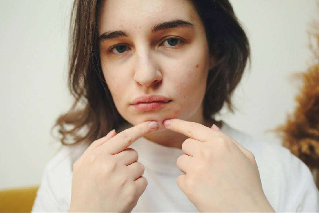 A woman is touching her acne on the oily skin