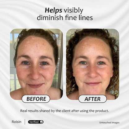 Before and after images of a client are shown with less visible lines after using DRSQ retinaldehyde