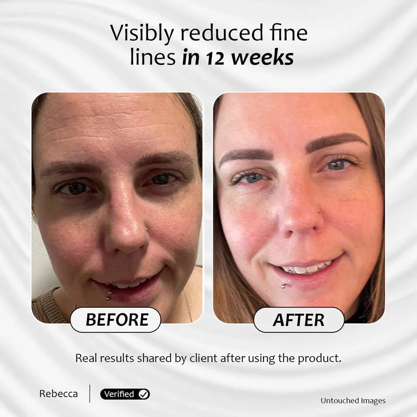 Before and after images of a client after using Advanced Vitamin A for 12 weeks