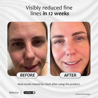 Before and after images of a client after using Advanced Vitamin A for 12 weeks