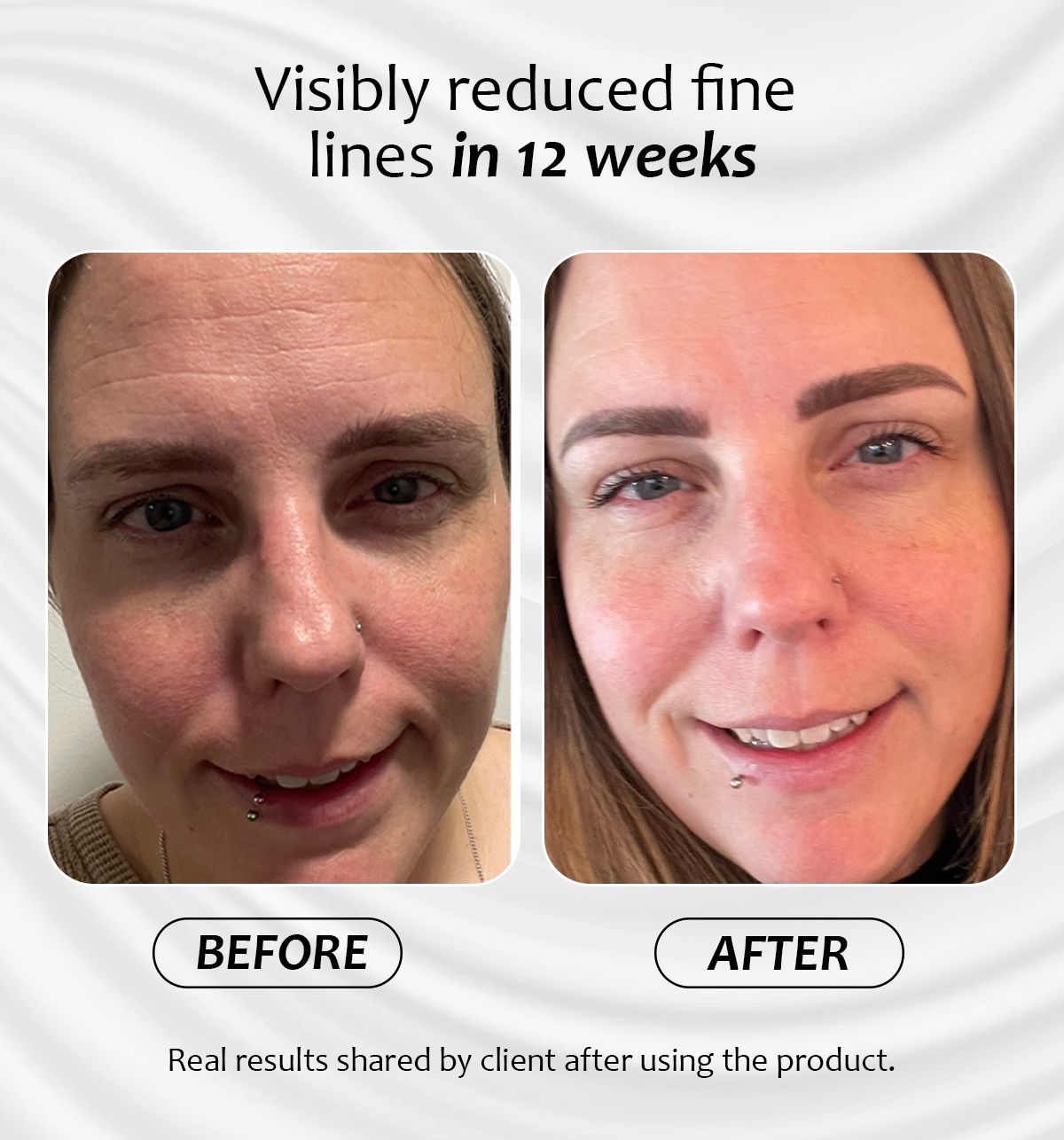 Before and after results of Miracle Pro-Vitamin Serum showing visibly reduced fine lines in 12 weeks 