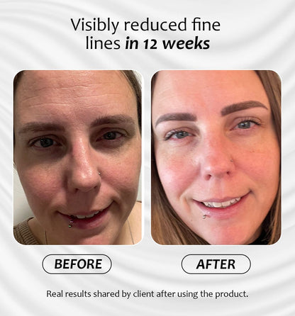 Before and after results of Miracle Pro-Vitamin Serum showing visibly reduced fine lines in 12 weeks 
