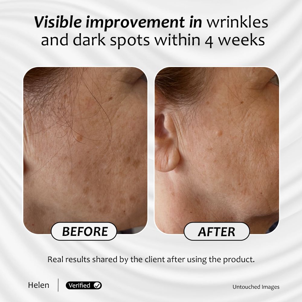 Client result images showing a visible reduction in dark spots after 4 weeks of Skin Bright serum use