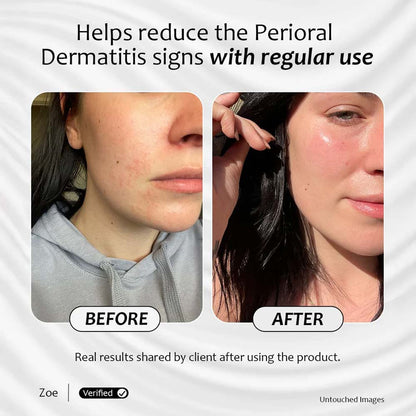 Before and after results of radiance 3d  Serum helps reduce the perioral dermatitis signs with regular use