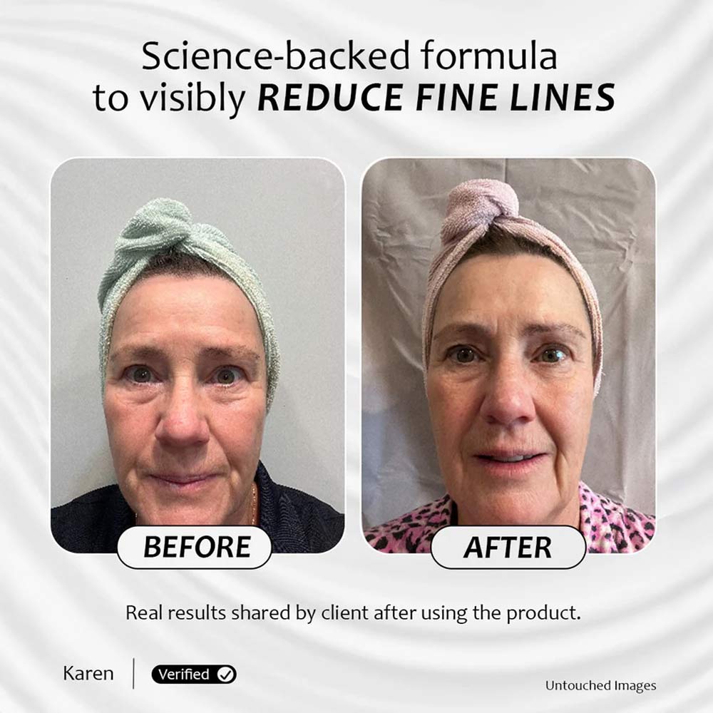 Before and after results of Renew & Glow Serum showing visibly reduced fine lines and smoother skin