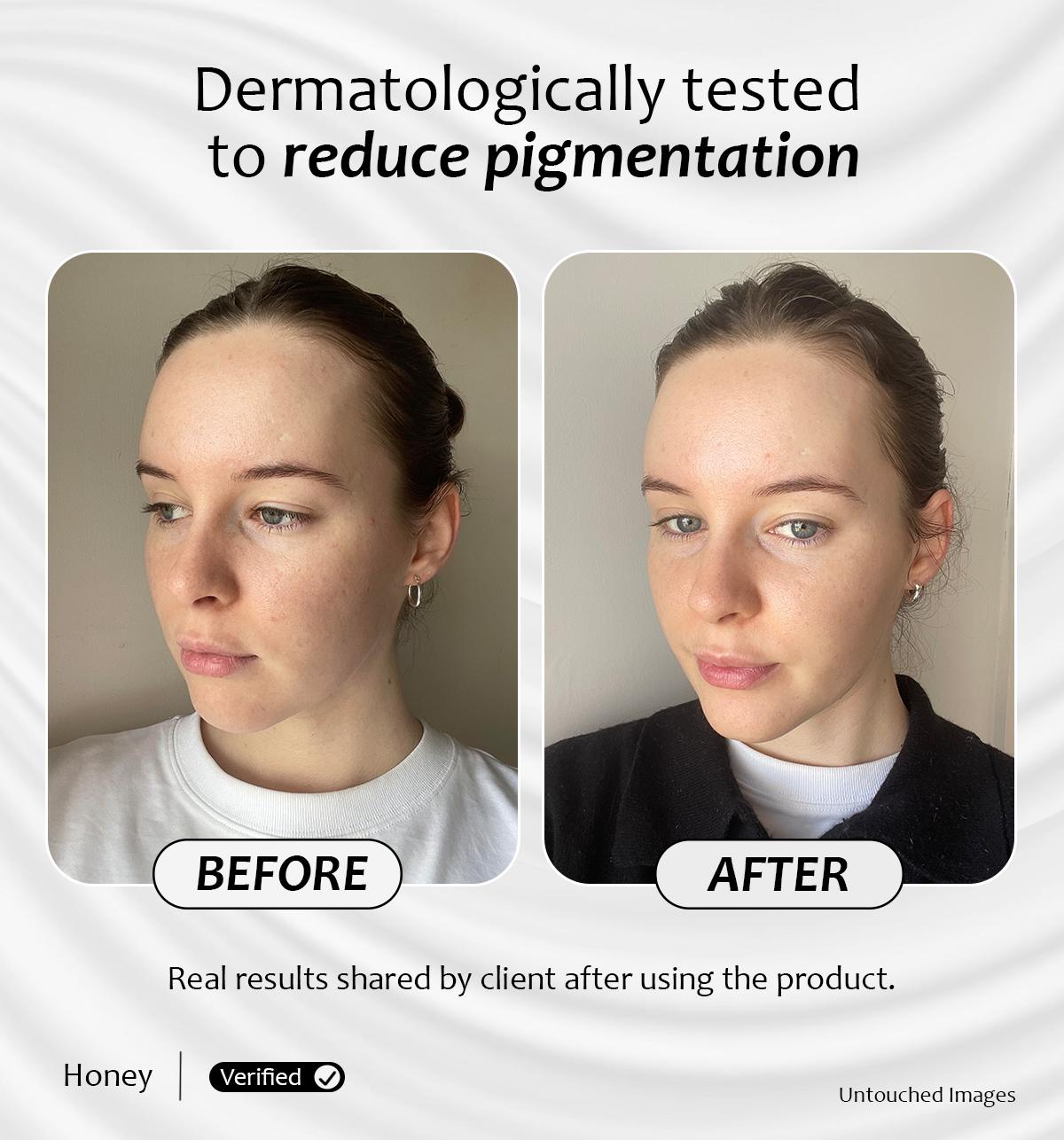 Before and after results showing reduced pigmentation using Vitamin A Starter product