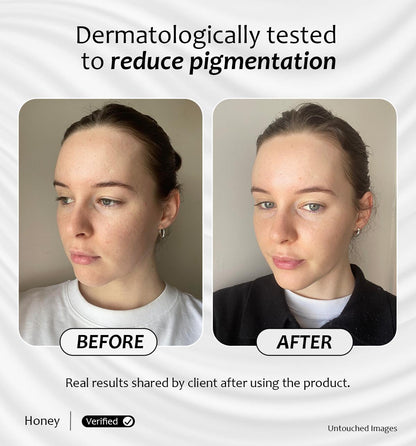 Before and after results showing reduced pigmentation using Vitamin A Starter product