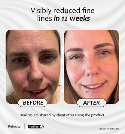 Before and after results of Miracle Pro-Vitamin Serum showing visibly reduced fine lines in 12 weeks 
