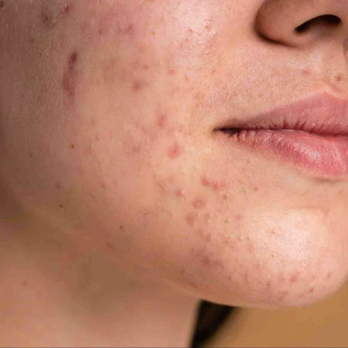 Post Acne Hyperpigmentation: Causes & Treatment