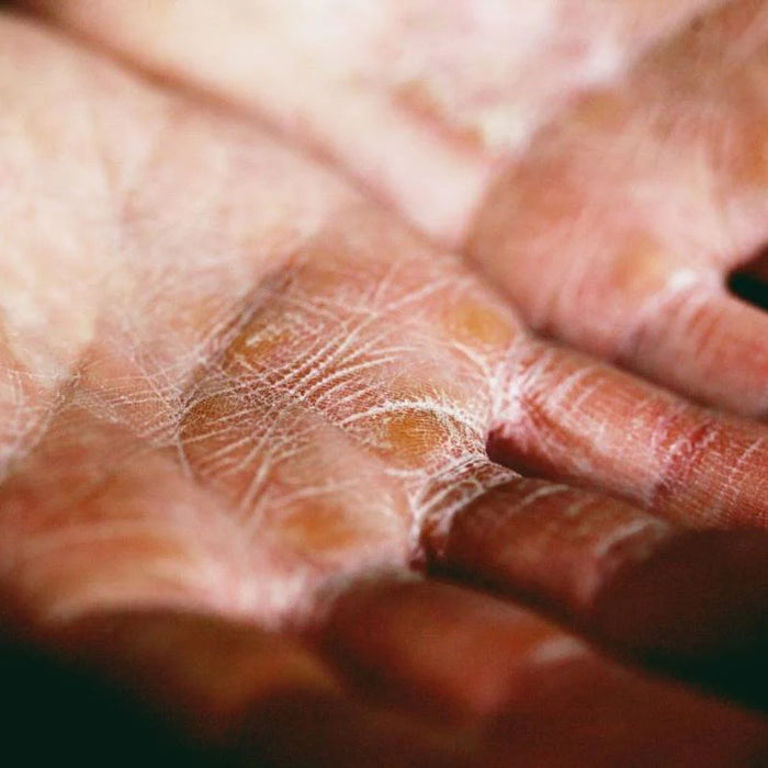 Very Dry Skin: Causes, Treatment, and Prevention Tips